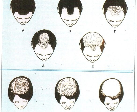 karakosta-dermatologos-afrodisiologos-peristeri-athina-genetiko-dna-test-alopekias